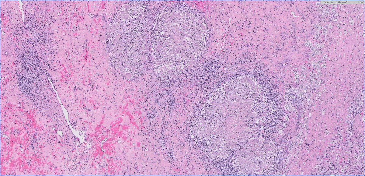 #GUpath 
60s M, h/o clear cell RCC with met to LN, now presents with adrenal gland mass, adrenalectomy performed

can you provide explanation for🔬?
 #pathstories