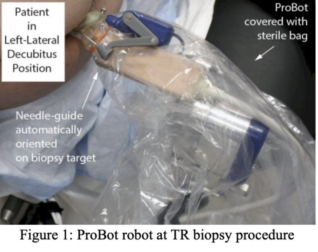UroToday.com (@urotoday) on Twitter photo A new ultrasound probe and robot for prostate biopsy. Presentation by Dan Stoianovici, PhD <a href="/brady_urology/">The Johns Hopkins Brady Urological Institute</a>. #EUS2025 written coverage by <a href="/tiffvnyhuang/">Tiffany Huang</a> > bit.ly/3EWklng #EngineeringandUrologySociety A new ultrasound probe and robot for prostate biopsy. Presentation by Dan Stoianovici, PhD <a href="/brady_urology/">The Johns Hopkins Brady Urological Institute</a>. #EUS2025 written coverage by <a href="/tiffvnyhuang/">Tiffany Huang</a> > bit.ly/3EWklng #EngineeringandUrologySociety