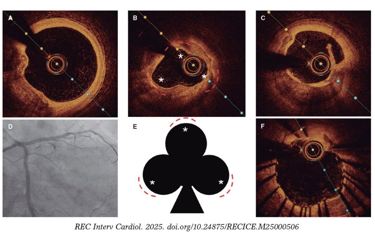 Alfonso Jurado-Román (@juradoromanal) on Twitter photo The #CloverSign ♣️
#OrbitalAtherectomy
<a href="/RevEspCardiol/">REC Publications</a> <a href="/shci_sec/">ACI-SEC: Hemodinamica</a> <a href="/JonZubiaur/">Jon Zubiaur Zamacola</a> <a href="/RaulmorenoMD/">Raul Moreno</a> <a href="/hemodin90/">Guillermo Galeote</a> <a href="/ari_gonzalvez/">Ariana Gonzálvez</a> <a href="/Dr_DanielTebar/">Daniel Tébar</a> <a href="/BorjaRiversa/">Borja Rivero Santana</a> <a href="/CardioHULP/">Cardiología La Paz</a> <a href="/PCRonline/">PCRonline 🫀</a> <a href="/JovenesSec/">JóvenesSEC</a> <a href="/Euro4cSpain/">Euro4cSpain</a>
recintervcardiol.org/en/images-in-c… The #CloverSign ♣️
#OrbitalAtherectomy
<a href="/RevEspCardiol/">REC Publications</a> <a href="/shci_sec/">ACI-SEC: Hemodinamica</a> <a href="/JonZubiaur/">Jon Zubiaur Zamacola</a> <a href="/RaulmorenoMD/">Raul Moreno</a> <a href="/hemodin90/">Guillermo Galeote</a> <a href="/ari_gonzalvez/">Ariana Gonzálvez</a> <a href="/Dr_DanielTebar/">Daniel Tébar</a> <a href="/BorjaRiversa/">Borja Rivero Santana</a> <a href="/CardioHULP/">Cardiología La Paz</a> <a href="/PCRonline/">PCRonline 🫀</a> <a href="/JovenesSec/">JóvenesSEC</a> <a href="/Euro4cSpain/">Euro4cSpain</a>
recintervcardiol.org/en/images-in-c…