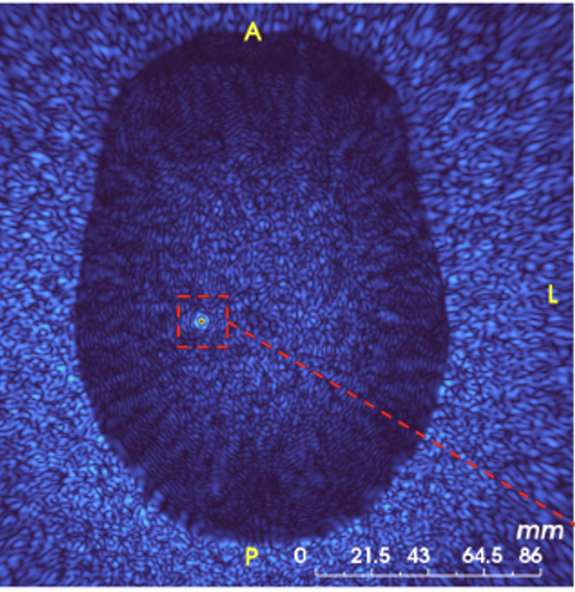 Wellcome Centre for Integrative Neuroimaging (@oxfordwin) on Twitter photo <a href="/NeuroecologyLab/">NeuroecologyLab</a> Building technological bridges: Ultrasound
Transcranial ultrasound stimulation (TUS) non-invasively targets deep brain areas. Advances from OxCIN & UCL now allow unprecedented precision and concurrent fMRI, opening new paths for therapeutic applications.
tinyurl.com/az625ap7 <a href="/NeuroecologyLab/">NeuroecologyLab</a> Building technological bridges: Ultrasound
Transcranial ultrasound stimulation (TUS) non-invasively targets deep brain areas. Advances from OxCIN & UCL now allow unprecedented precision and concurrent fMRI, opening new paths for therapeutic applications.
tinyurl.com/az625ap7