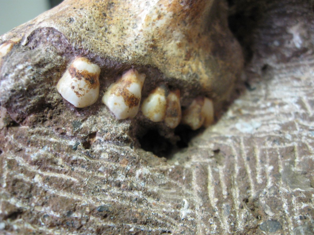 A close up of the calculus and tartar on the teeth of MH-1 from #Malapa – discovered because of a CT scan showing the hollow under the first and second molars. This led to a paper in <a href="/Nature/">nature</a>  by Henry et al 2012 on the diet of #sediba as the dental calculus contained plant