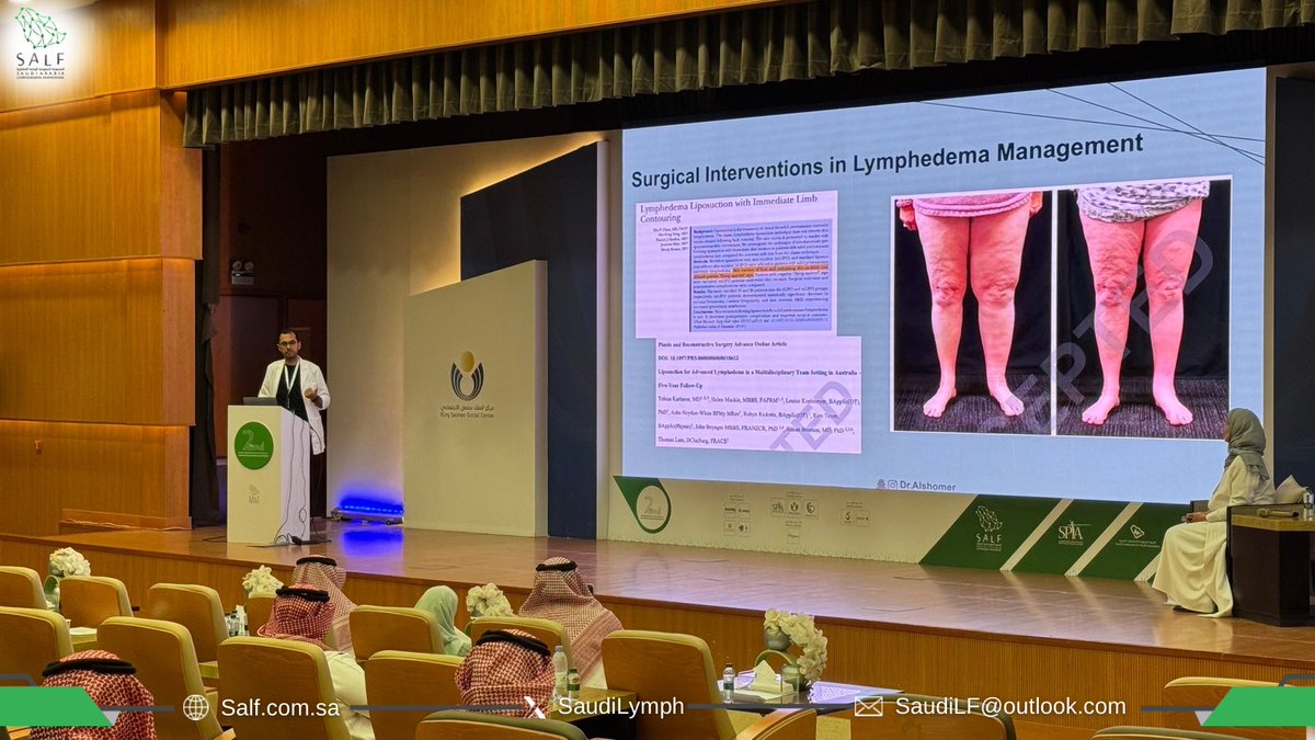 Saudi Arabia Lymphoedema Framework (SALF) (@saudilymph) on Twitter photo Listening to “Lipedema Surgery: Who is a Potential Suitable Candidate?” by Dr. Feras Alshomer.
An overview for refining surgical decision making.
<a href="/feras_shomer/">feras alshomer</a>
#SALF25 Listening to “Lipedema Surgery: Who is a Potential Suitable Candidate?” by Dr. Feras Alshomer.
An overview for refining surgical decision making.
<a href="/feras_shomer/">feras alshomer</a>
#SALF25
