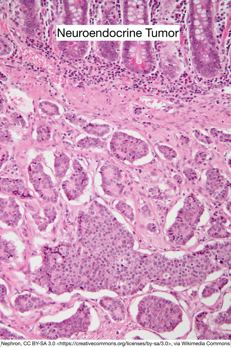 Some Neuroendocrine Neoplasm Factoids 😵‍💫 

Neuroendocrine CARCINOMA is high grade by definition

No need to say High Grade Neuroendocrine Carcinoma; it's redundant

Grade 3 Neuroendocrine TUMOR is different than Neuroendocrine CARCINOMA 

#pathx #endocrine #pathology
