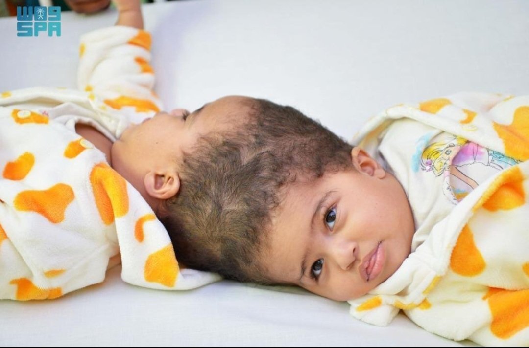 انجاز طبي سعودي جديد:

نجاح عملية فصل التوأم السيامي الإريتري “أسماء وسمية” بعد عملية استغرقت 15 ساعة 🇸🇦❤️