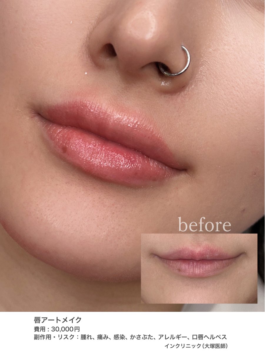 リップアートメイクの人中短縮効果すごい！！
メイクより自然に垢抜抜けてる🐈