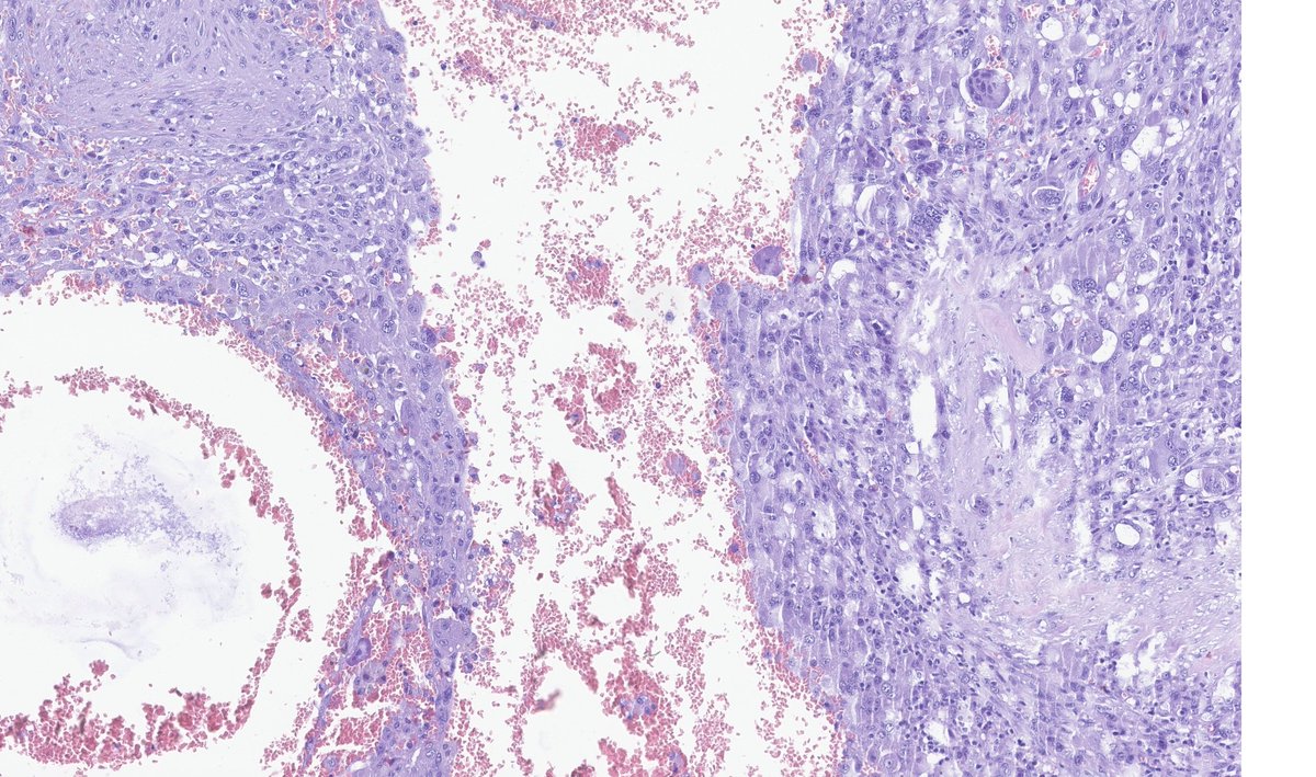 pancreatic ductal adenocarcinoma (PDAC) can have some unusual morphology! In this case,e giant cells osteoclast-like!