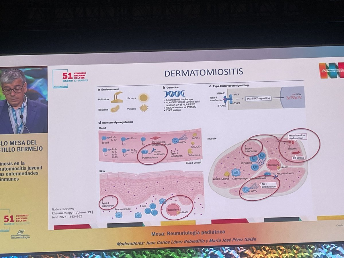 Calcinosis en las enfermedades reumatológicas sistémicas en pediatría como en la DMJ siendo más frecuente en esta patología aunque también puede verse en el LES y en la esclerosis sistémica <a href="/SEReumatologia/">Soc.Esp.Reumatología</a> <a href="/SERPE_ReuPed/">SERPE</a> #SER2025