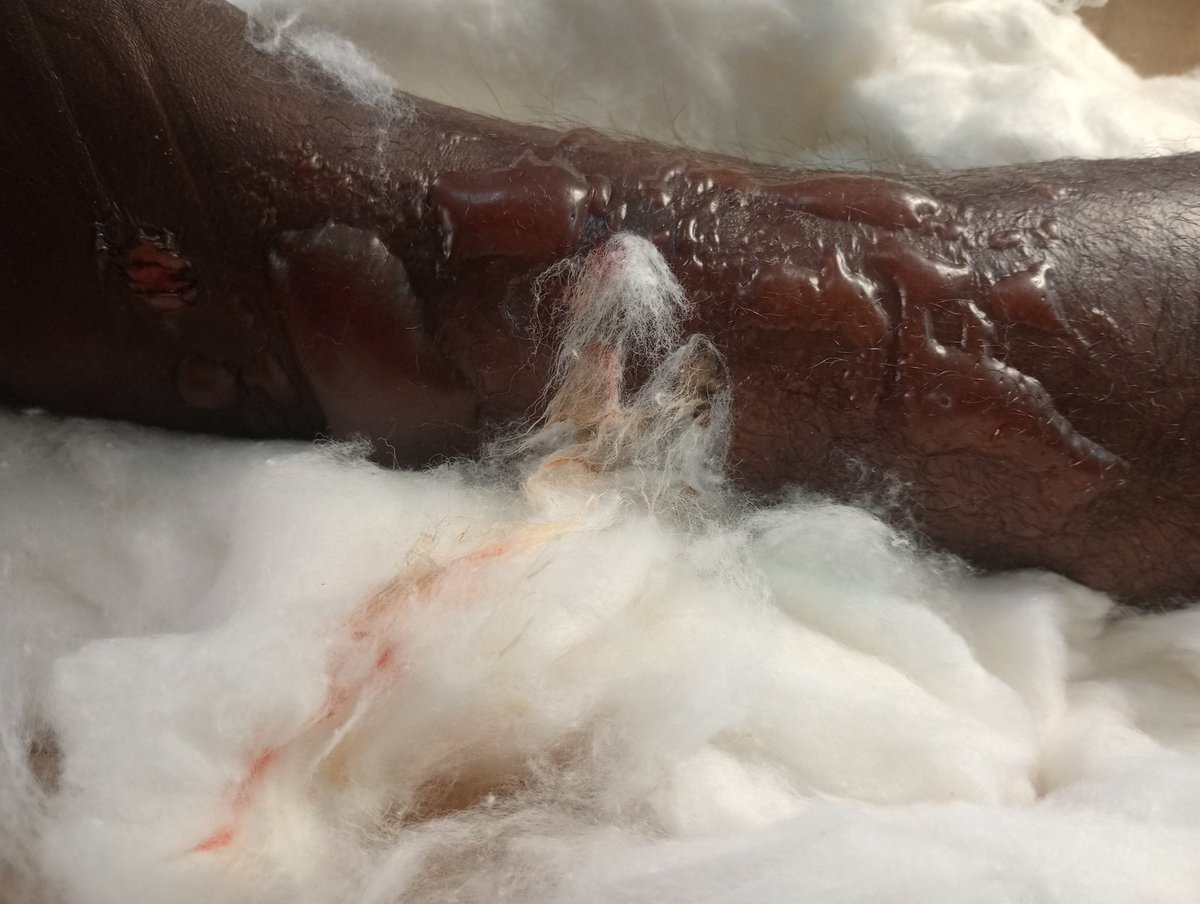 Broken bones should not be treated or delayed at home.The risks of complications and loss of limb or life are high.