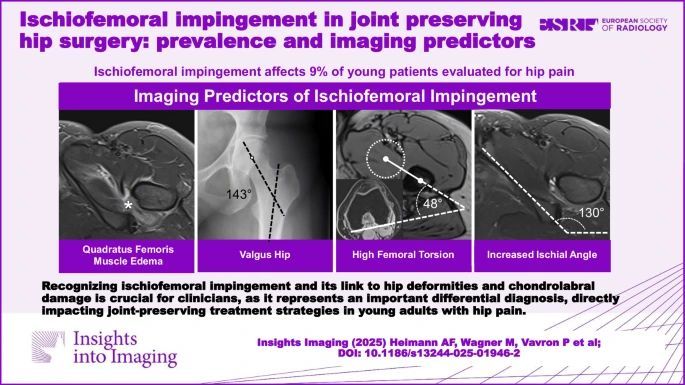 This study aimed to determine the prevalence of ischiofemoral impingement in young patients evaluated for joint-preserving hip surgery - the comparable prevalence of labral lesions but lower prevalence of cartilage damage suggests complex relationships between extra- and