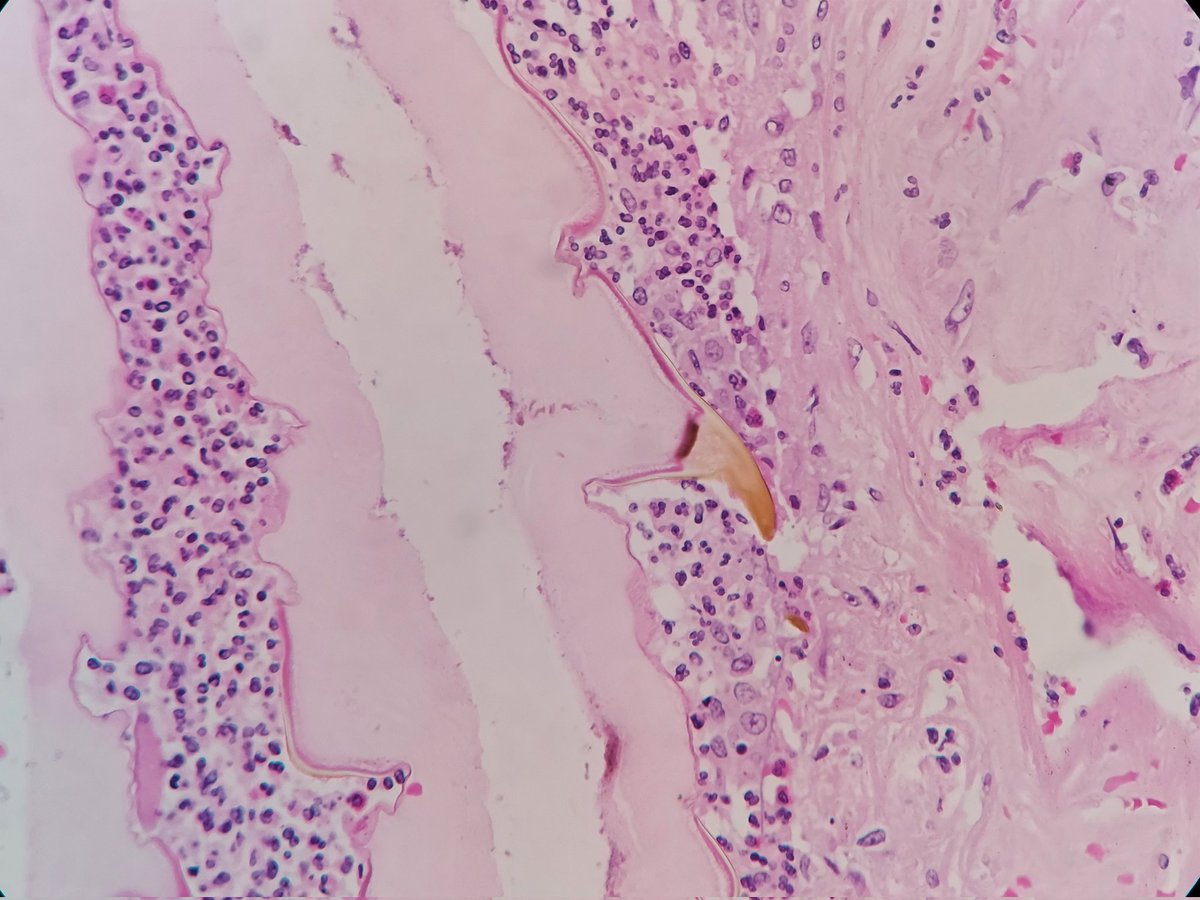 padmapathology1's tweet image. Incidental finding in penectomy specimen, in the necrotic areas. Features of squamous cell carcinoma seen in preserved focus. 
Thinking of dead worm. Any definite diagnosis? 
Please opine.
#PathTwitter
@ParasiteGal @yro854 @Histopatolomon @DrGeeONE 
#IDpath #crittersontwitter