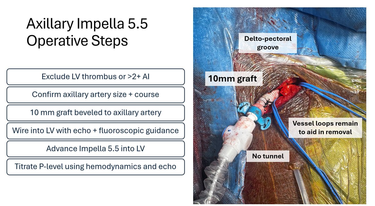 Anthony Zaki, MD (@anthonyzakimd) on Twitter photo Simplified Axillary #Impella 5.5 Operative Technique via DP groove <a href="/CleClinicHVTI/">Cleveland Clinic Heart, Vascular & Thoracic</a> <a href="/JJMTHeartRecHCP/">Johnson & Johnson MedTech | HeartRecovery for HCPs</a> #cardiogenicshock #LV #unloading #ecmo #heartfailure Simplified Axillary #Impella 5.5 Operative Technique via DP groove <a href="/CleClinicHVTI/">Cleveland Clinic Heart, Vascular & Thoracic</a> <a href="/JJMTHeartRecHCP/">Johnson & Johnson MedTech | HeartRecovery for HCPs</a> #cardiogenicshock #LV #unloading #ecmo #heartfailure