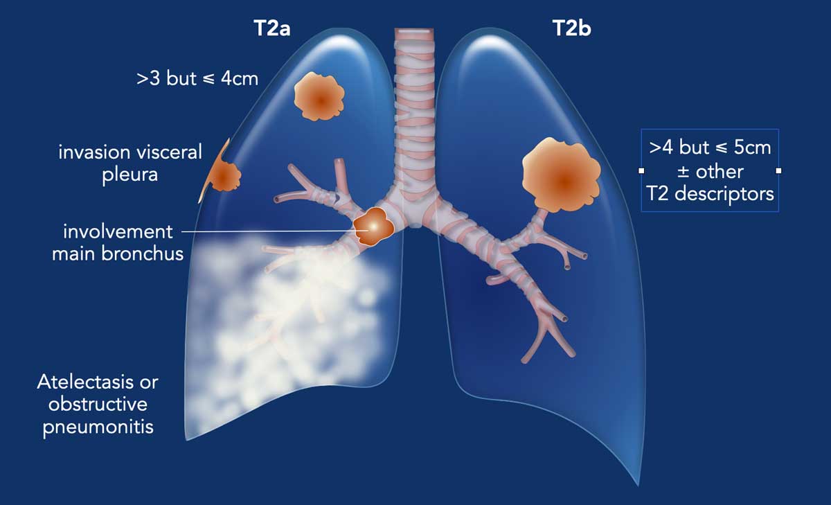 dr_yakupergun's tweet photo. TNM classification 9ᵗʰ edition

T stage

https://t.co/yA7h7sgLYH https://t.co/abGbPnZUIg