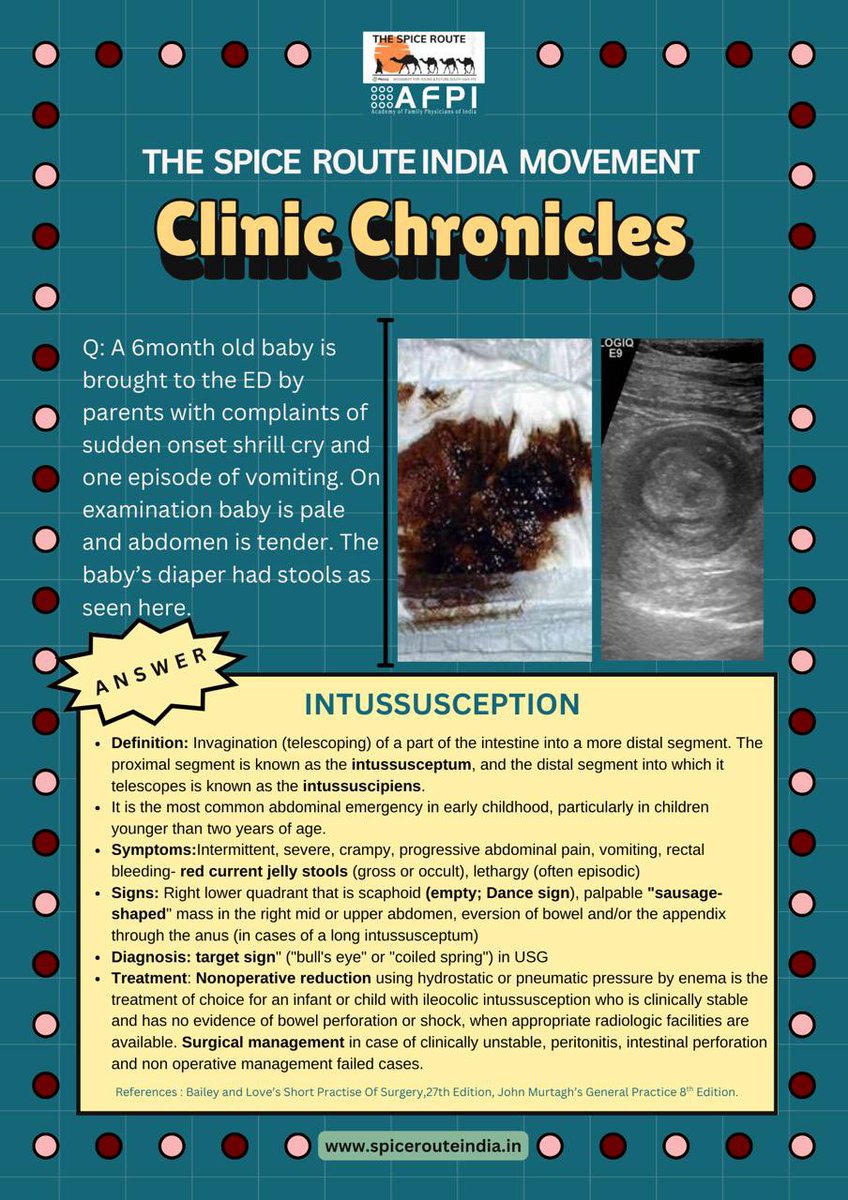 The Spice Route India Movement brings to you a new topic in the series of Clinic Chronicles!

Intussuception is a common pediatric case ! 

Proper counseling &amp; non operative reduction at the earliest is needed.

#clinicchronicles
#spicerouteindia
#proudtobeafamilyphysician