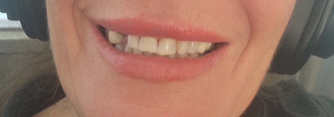 I had a capped tooth right in the front of my mouth because it was discolored due to a root canal. Anyway, the bloody thing has completely snapped. I now look like a junkie with my missing front tooth.
329 quid to replace it with a bridge.
Great start to my birthday 

FFS 🤣🤣🤣