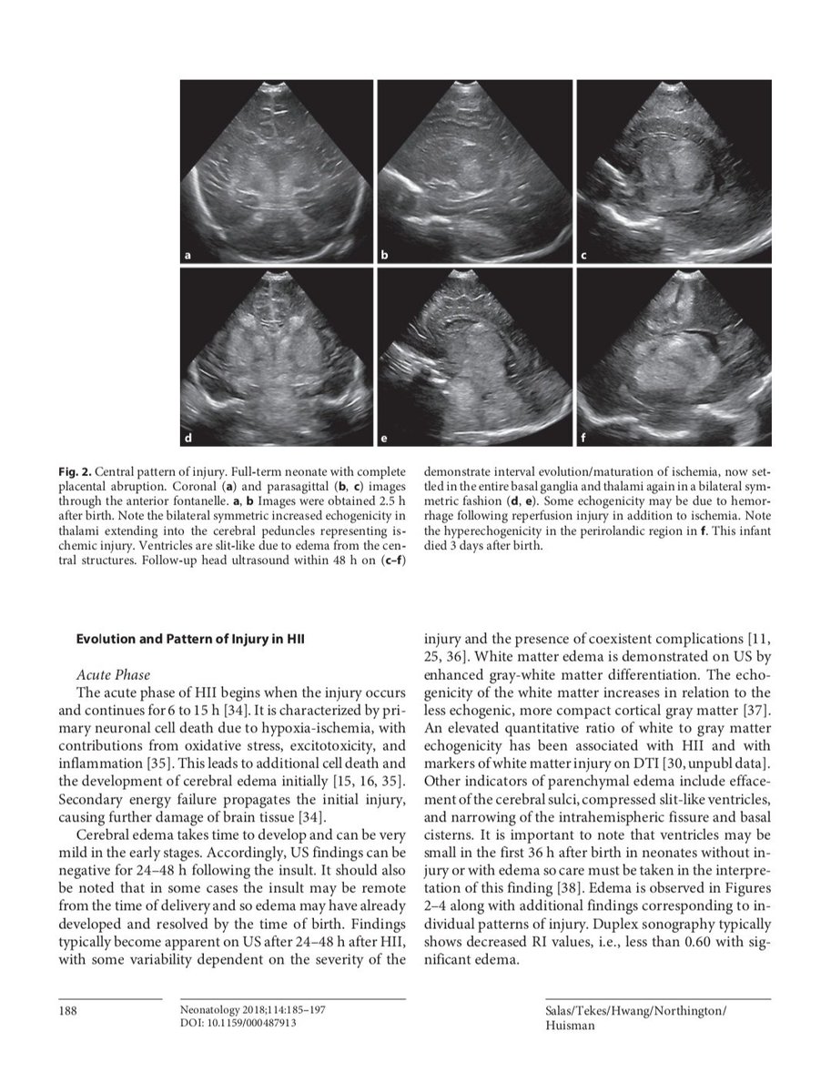 Joaquín Martínez (@jmmr83) on Twitter photo Ultrasonido en encefalopatía hipóxico-isquémica
<a href="/NephroP/">NephroPOCUS</a> <a href="/OswaldoRamosN/">Dr. Oswaldo Ramos</a> <a href="/y_interna/">Medicina Interna. Lo miro y mañana te digo.</a> <a href="/SonoSamMD/">Samuel García Rubio</a> <a href="/curromir/">Curro Miralles</a> <a href="/zbriote/">José António Briote Mariz</a> <a href="/ABCDEcografia/">ABCDEcografía</a> <a href="/anaseguragrau/">AnaSegura</a> <a href="/PierpaDiNick/">Pierpaolo Di Nicolò</a> <a href="/jpalacinp/">Jose Maria Palacin</a> <a href="/jorgezzb/">Jorge Zegarra</a> <a href="/AlvarezHigueras/">Fco. Javier Alvarez Higueras</a> <a href="/EcosemfyC/">EcosemFYC</a> <a href="/USPed_Latam/">USPed</a> Ultrasonido en encefalopatía hipóxico-isquémica
<a href="/NephroP/">NephroPOCUS</a> <a href="/OswaldoRamosN/">Dr. Oswaldo Ramos</a> <a href="/y_interna/">Medicina Interna. Lo miro y mañana te digo.</a> <a href="/SonoSamMD/">Samuel García Rubio</a> <a href="/curromir/">Curro Miralles</a> <a href="/zbriote/">José António Briote Mariz</a> <a href="/ABCDEcografia/">ABCDEcografía</a> <a href="/anaseguragrau/">AnaSegura</a> <a href="/PierpaDiNick/">Pierpaolo Di Nicolò</a> <a href="/jpalacinp/">Jose Maria Palacin</a> <a href="/jorgezzb/">Jorge Zegarra</a> <a href="/AlvarezHigueras/">Fco. Javier Alvarez Higueras</a> <a href="/EcosemfyC/">EcosemFYC</a> <a href="/USPed_Latam/">USPed</a>