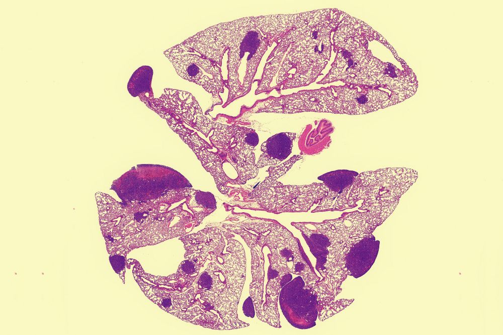 Chan Zuckerberg Biohub Network (@czbiohub) on Twitter photo 🚨 #CZBiohubNY Investigator <a href="/SohailTavazoie/">Sohail Tavazoie</a> of @rockefelleruniv finds an inherited variant in cholesterol-controlling gene PCSK9 can drive metastasis in #breastcancer, suggesting that certain cholesterol drugs could be used in cancer therapy.
Read more ⤵️
czi.co/4jTi4Zt 🚨 #CZBiohubNY Investigator <a href="/SohailTavazoie/">Sohail Tavazoie</a> of @rockefelleruniv finds an inherited variant in cholesterol-controlling gene PCSK9 can drive metastasis in #breastcancer, suggesting that certain cholesterol drugs could be used in cancer therapy.
Read more ⤵️
czi.co/4jTi4Zt