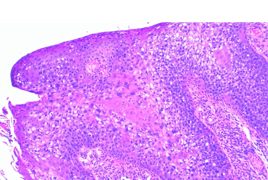 Trichilemmal carcinoma

Lobules with sharp borders continuous with the epidermis

Cytoplasm vacuoles

Atypical cells

Trichilemmal keratinization

Peripheral palisading

#path #pathology #medicine #dermatology #dermpath #derm