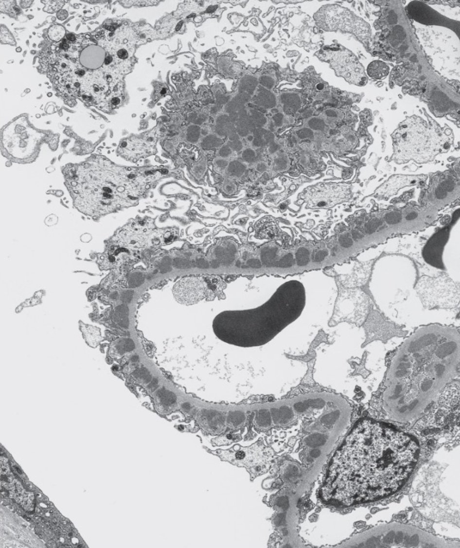 🔬 La microscopía electrónica es clave en biopsia renal.
En ~20% de los casos es imprescindible para un diagnóstico final.Aunque a veces se prescinde si LM o IF son concluyentes, esto puede llevar a diagnósticos erróneos o incompletos.
No es un lujo, es diagnóstico.