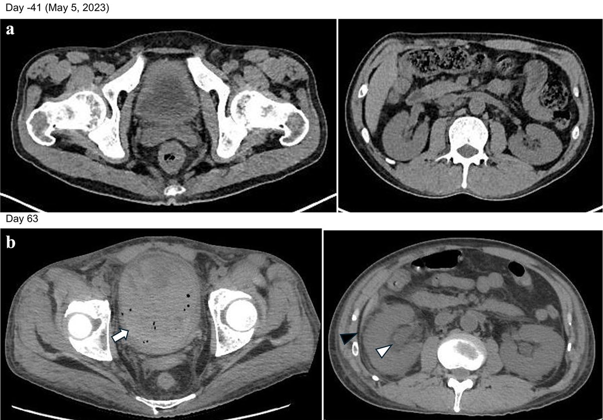WJON_Journal's tweet image. 📢 New Research Published!
"#Solitary #Synchronous #Biliary Metastasis in #Colorectal #Adenocarcinoma" authored by Dr. Mark D. Girgis.
wjon.elmerpub.com/wjon/article/v…