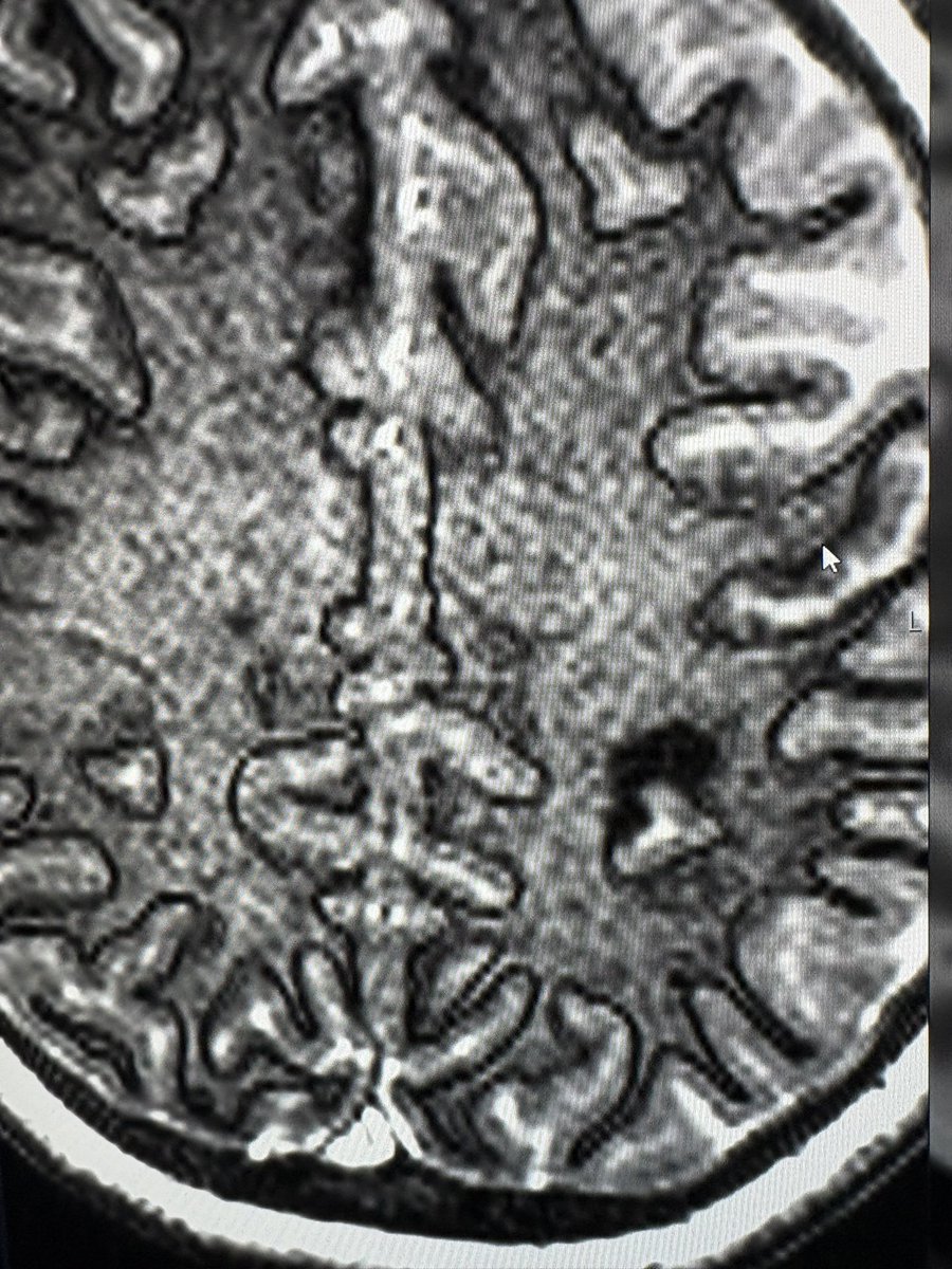 Can you see the extension of the lesion on these MP2RAGE and EDGE images ? 
Beautiful example Of the usefulness of more advanced / optimised MRI protocol for epilepsy !