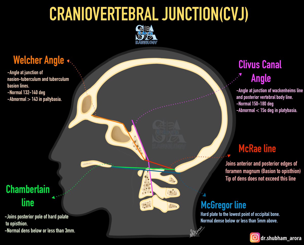 Dr_S_Arora's tweet image. Slide on angles and lines of craniovertebral junction.
#radiology #MedX