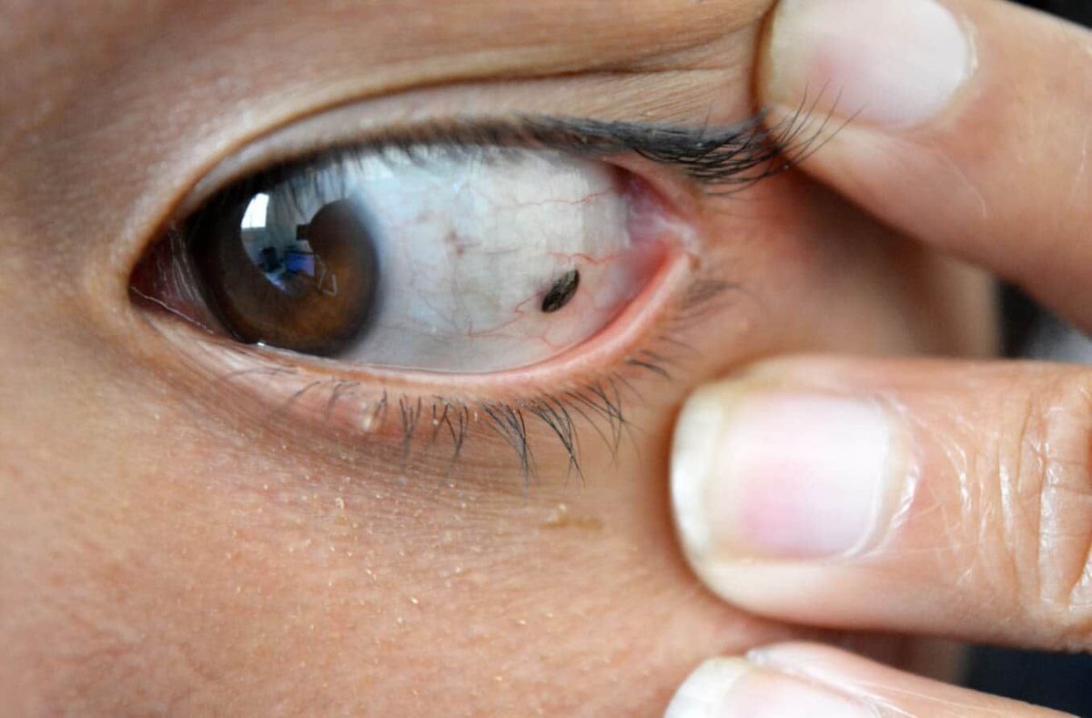 May is Ocular Melanoma Awareness Month—a time to shine a light on this rare but serious #EyeCancer. Early detection is key, so don’t skip those regular eye exams. Learn the signs, risk factors and why awareness matters: allaboutvision.com/resources/news…  
        
#OcularMelanomaAwareness
