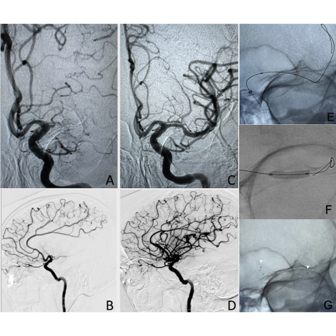 JNIS (@jnis_bmj) on Twitter photo 🚨 BREAKTHROUGH IN STROKE CARE! 🚨
A new study shows the feasibility of a single-step technique using the MINI TREK II OTW balloon for deploying the Neuroform Atlas stent in intracranial atherosclerosis-related large vessel occlusions. This method eliminates the need for an 🚨 BREAKTHROUGH IN STROKE CARE! 🚨
A new study shows the feasibility of a single-step technique using the MINI TREK II OTW balloon for deploying the Neuroform Atlas stent in intracranial atherosclerosis-related large vessel occlusions. This method eliminates the need for an