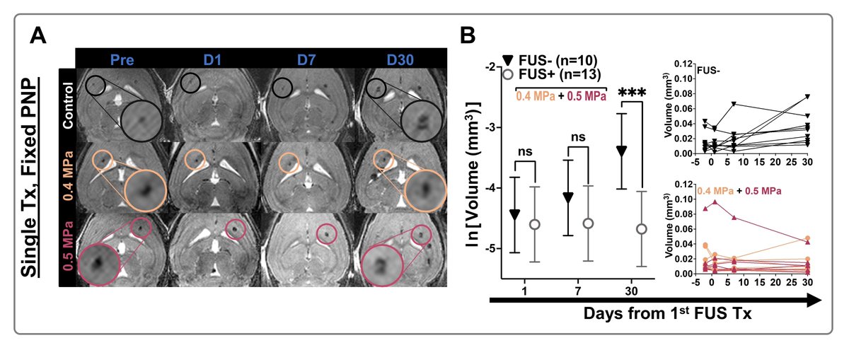 Price Lab @ University of Virginia (@pricelabuvabme) on Twitter photo The fascinating and unexpected stabilization response of cavernomas to focused ultrasound. Our newest is now out in <a href="/natBME/">Nature Biomedical Engineering</a>. Led by <a href="/DataDelaney/">Delaney Fisher</a> with tons of help from many terrific lab members and multiple collaborators! rdcu.be/elRyP The fascinating and unexpected stabilization response of cavernomas to focused ultrasound. Our newest is now out in <a href="/natBME/">Nature Biomedical Engineering</a>. Led by <a href="/DataDelaney/">Delaney Fisher</a> with tons of help from many terrific lab members and multiple collaborators! rdcu.be/elRyP