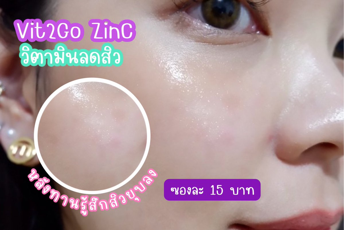 queen1654's tweet photo. Vit2Go ZinC วิตามินลดสิว ซองละ 15฿ เค้าเกินราคาไปมาก หลังใช้รู้สึกสิวยุบ หน้ามันน้อยลง ช่วยลดรูขุมขนด้วย มี2สูตร Girl และ Boy พกพาง่ายหยิบสะดวก ทานแค่วันละ 1 ซองหลังอาหารเอง
#Vit2Go #Vit2GoZinC #Vit2GoHeyboy #Vit2goHeyGirl #Vit2GoวิตามินลดสิวสูตรGenZ #Handyherb https://t.co/H1YTDHhTRA