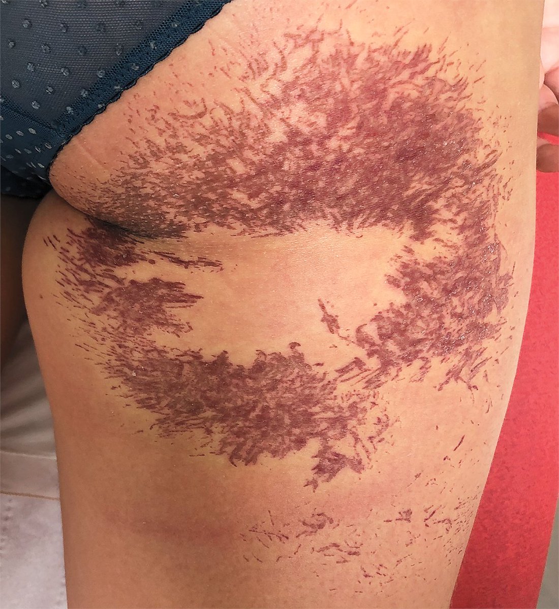 Images in Clinical Medicine: Sea Anemone Sting nej.md/3YCMneq

#DermTwitter