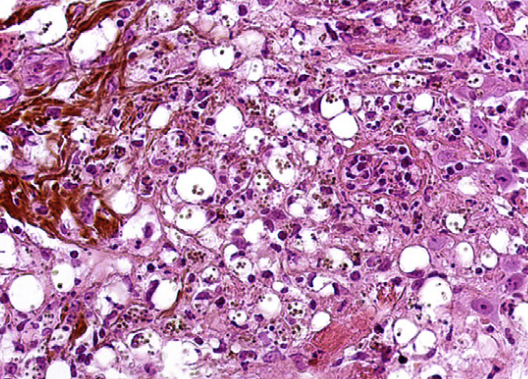 PenafortPaulo's tweet photo. We reported the first case of oral histoplasmosis in a patient on Secukinumab (Cosentyx), an IL-17 inhibitor. A rare opportunistic infection in a 42-year-old woman with ankylosing spondylitis stresses the need for vigilance in patients on immunomodulators. https://t.co/hjHAfpxd60 https://t.co/b5WLlzK7Or
