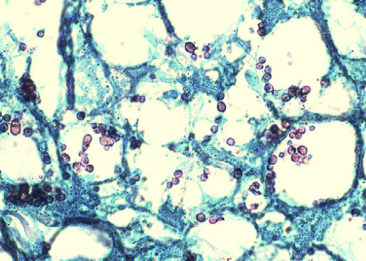PenafortPaulo's tweet photo. We reported the first case of oral histoplasmosis in a patient on Secukinumab (Cosentyx), an IL-17 inhibitor. A rare opportunistic infection in a 42-year-old woman with ankylosing spondylitis stresses the need for vigilance in patients on immunomodulators. https://t.co/hjHAfpxd60 https://t.co/b5WLlzK7Or