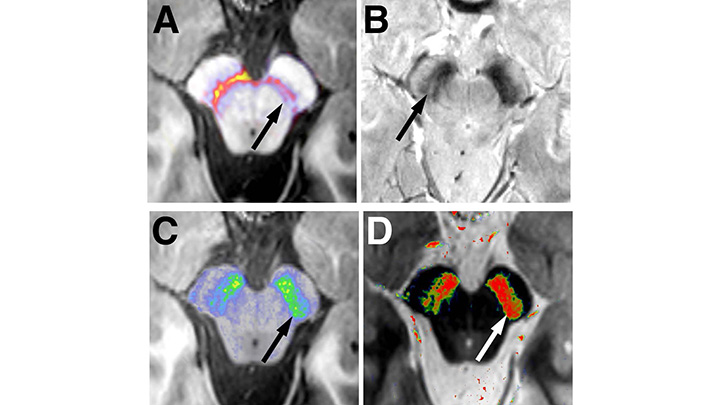 Mayo Clinic Proceedings (@mayoproceedings) on Twitter photo Medical image: A differential diagnosis of idiopathic Parkinson disease vs atypical parkinsonian disorder was considered, with idiopathic Parkinson disease being favored based on examination findings.
mayocl.in/438redq Medical image: A differential diagnosis of idiopathic Parkinson disease vs atypical parkinsonian disorder was considered, with idiopathic Parkinson disease being favored based on examination findings.
mayocl.in/438redq