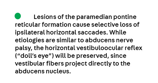 Key Point 4 from the article Supranuclear Disorders of Eye Movements by Dr. Gregory P. Van Stavern, from the April #Neuroophthalmology issue, which is available to subscribers at hubs.la/Q03kdQbS0
#Neurology #NeuroTwitter #MedEd