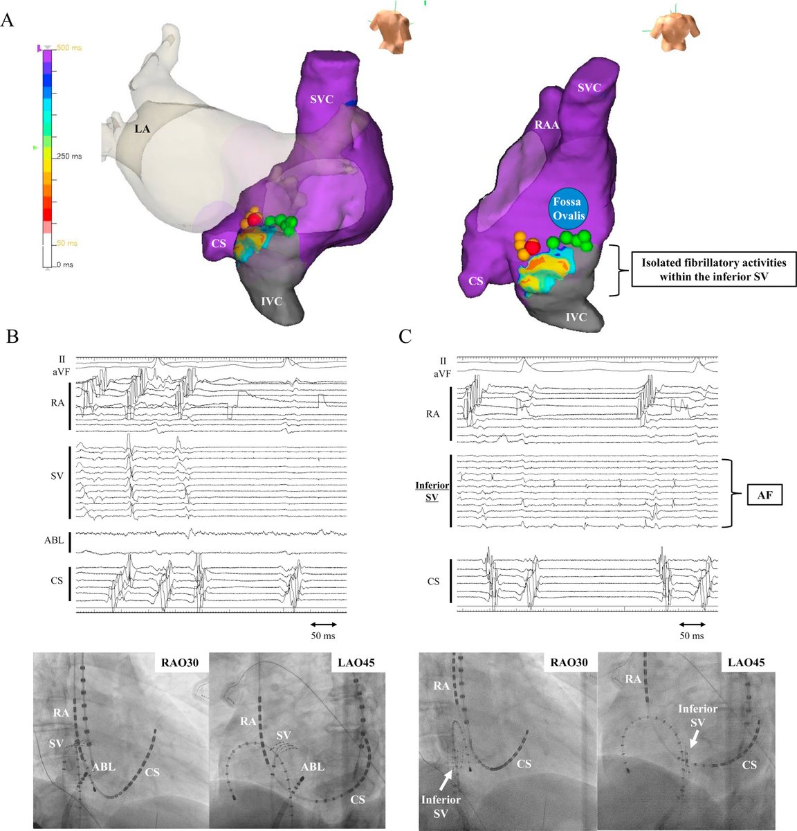 Localized atrial fibrillation within the inferior sinus venosa treated by isolation; could it be a new target of ablation for persistent atrial fibrillation? 
heartrhythmcasereports.com/article/S2214-…