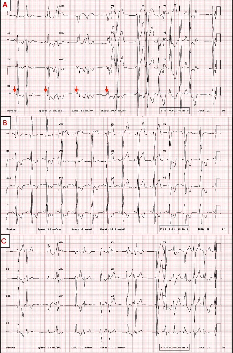 Heart Rhythm Case Reports (@hrs_casereports) on Twitter photo How Narrow is Narrow QRS in Premature Ventricular Contractions? A Novel Variant of SCN5A-Associated MEPPC
<a href="/oguzhanekrem/">Oğuzhan Ekrem</a> @yigityilanci @happyEP <a href="/universitemDEU/">Dokuz Eylül Üniversitesi</a>
heartrhythmcasereports.com/article/S2214-… How Narrow is Narrow QRS in Premature Ventricular Contractions? A Novel Variant of SCN5A-Associated MEPPC
<a href="/oguzhanekrem/">Oğuzhan Ekrem</a> @yigityilanci @happyEP <a href="/universitemDEU/">Dokuz Eylül Üniversitesi</a>
heartrhythmcasereports.com/article/S2214-…