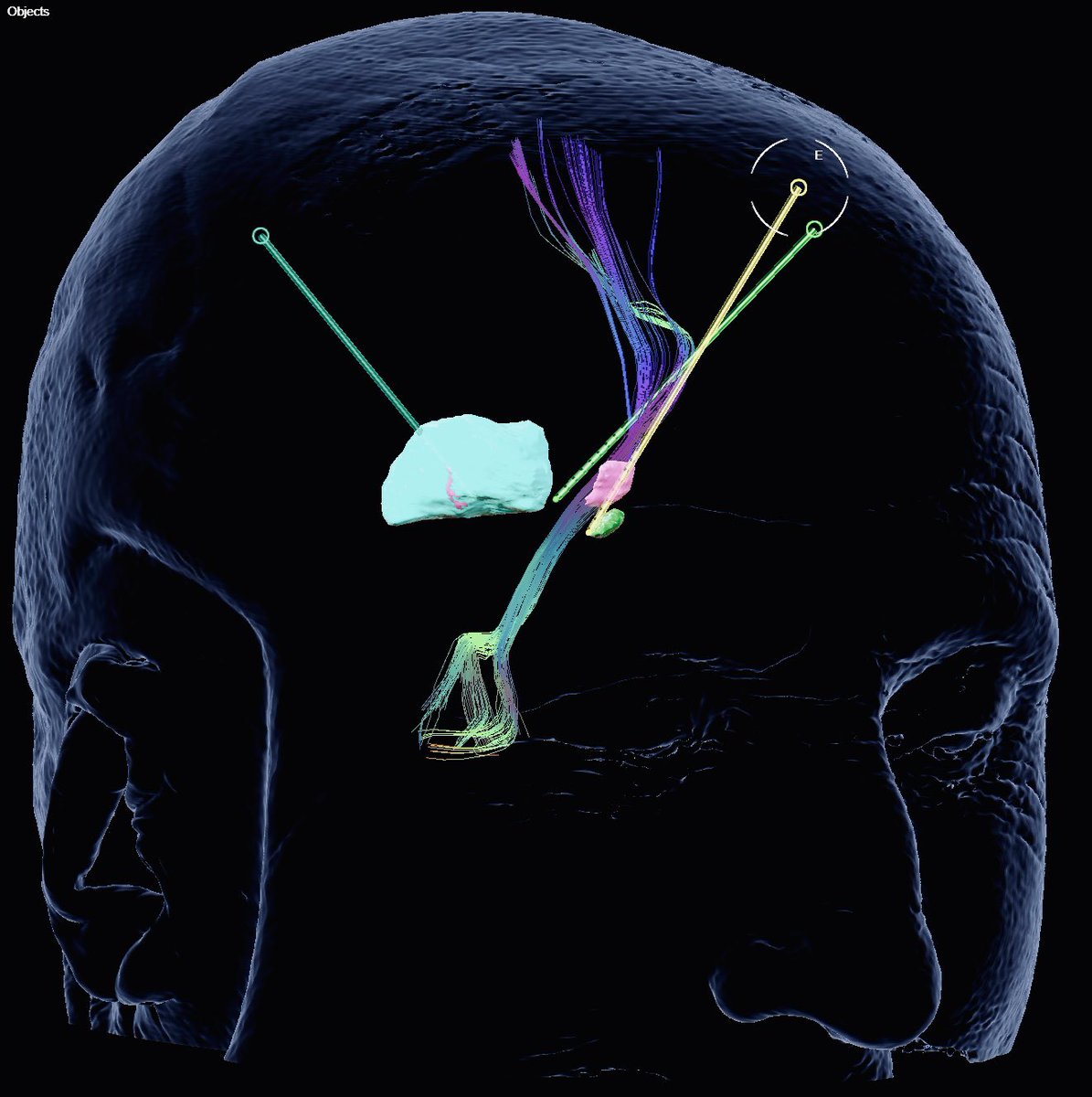 ▶️Triple diana , doble tratamiento, mismo  paciente . DBS en Dolor Neuropatico y Temblor 

✅Unidad de Neuromodulacion y Dolor 
<a href="/hospitaldelmar/">Hospital del Mar</a>