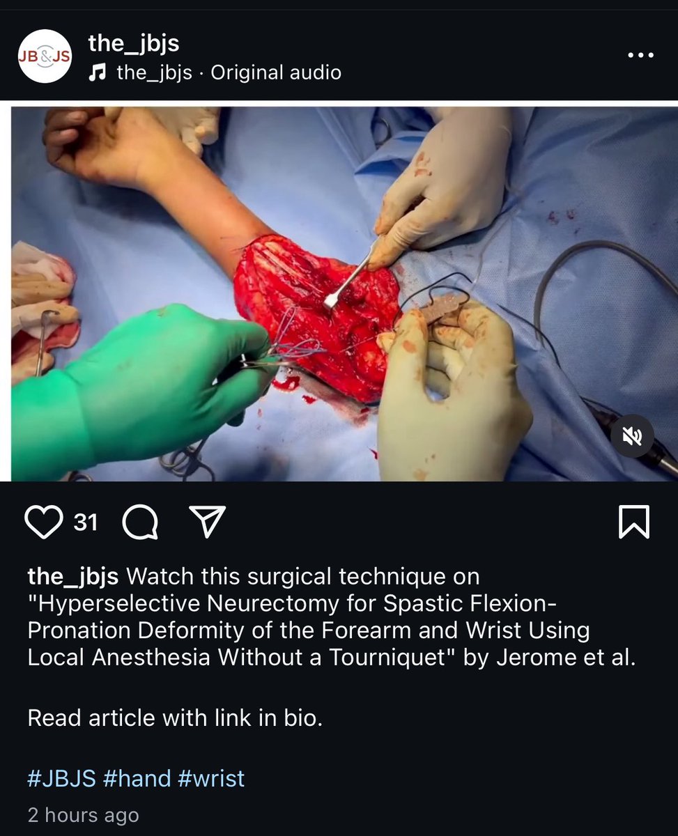 Terrence Jose Jerome, FRCS (@terrencejose) on Twitter photo Just published in <a href="/jbjs/">J Bone & Joint Surg</a>
“Hyperselective Neurectomy for Spastic Flexion-Pronation Deformity Under Local Anesthesia Without Tourniquet” by Jerome.
instagram.com/reel/DJmbWX8AL…
<a href="/jbjs/">J Bone & Joint Surg</a> <a href="/JHSEur/">The Journal of Hand Surgery (European Volume)</a> <a href="/JHandSurg/">J Hand Surg Am- ASSH</a> <a href="/BSSHand/">British Society for Surgery of the Hand</a> <a href="/FESSHEurope/">FESSH</a> <a href="/AAOS1/">AAOS</a> <a href="/prsjournal/">Plastic and Reconstructive Surgery</a> <a href="/PRSGlobalOpen/">PRS Global Open</a> <a href="/JHSGlobalOnline/">JHS GO</a> <a href="/BgTalkinman/">Brent Graham</a> Just published in <a href="/jbjs/">J Bone & Joint Surg</a>
“Hyperselective Neurectomy for Spastic Flexion-Pronation Deformity Under Local Anesthesia Without Tourniquet” by Jerome.
instagram.com/reel/DJmbWX8AL…
<a href="/jbjs/">J Bone & Joint Surg</a> <a href="/JHSEur/">The Journal of Hand Surgery (European Volume)</a> <a href="/JHandSurg/">J Hand Surg Am- ASSH</a> <a href="/BSSHand/">British Society for Surgery of the Hand</a> <a href="/FESSHEurope/">FESSH</a> <a href="/AAOS1/">AAOS</a> <a href="/prsjournal/">Plastic and Reconstructive Surgery</a> <a href="/PRSGlobalOpen/">PRS Global Open</a> <a href="/JHSGlobalOnline/">JHS GO</a> <a href="/BgTalkinman/">Brent Graham</a>