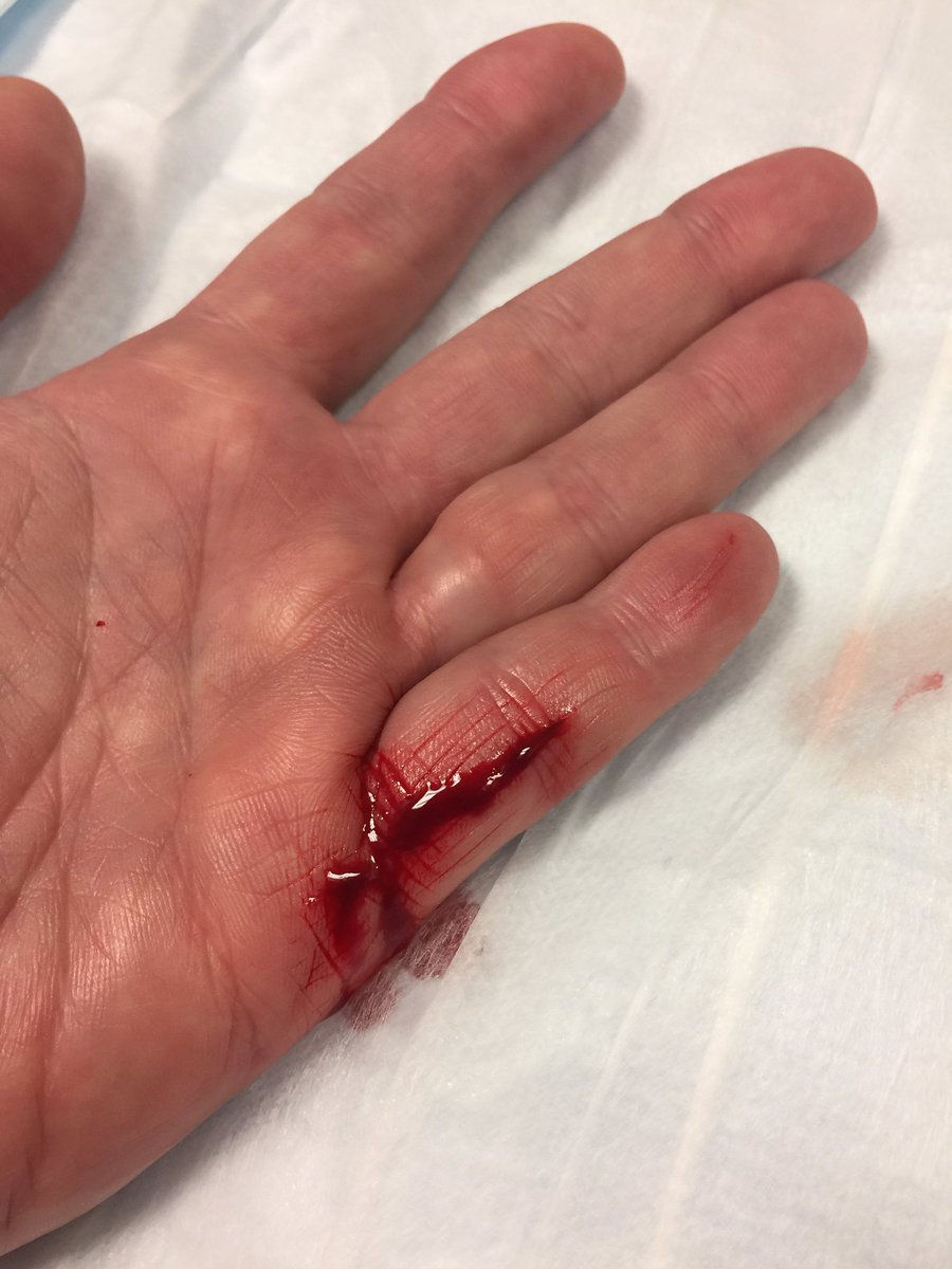 I told him he have to get stitches as the cut is too deep for glue or to heal normally. Full disclosure: he has never had stitches in his life. Here goes... @surgeonRichards