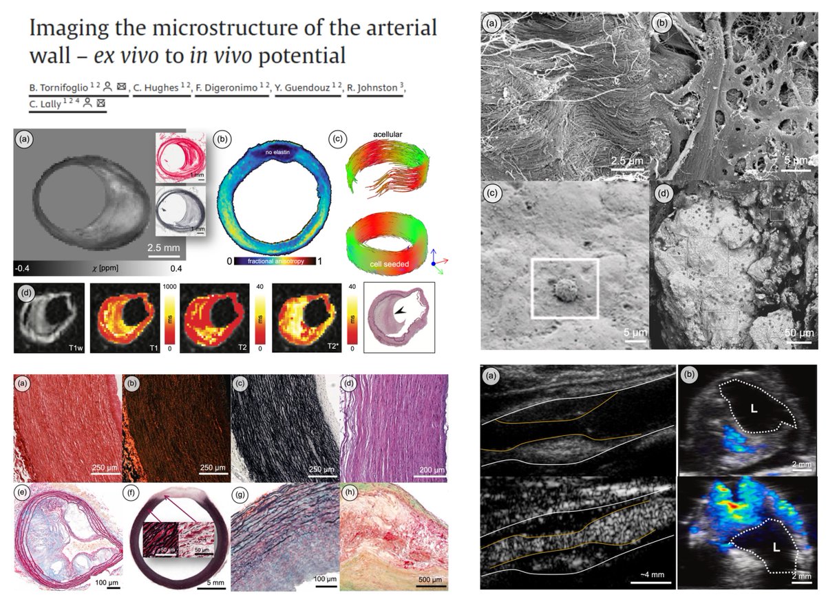 HaoYin20's tweet image. Imaging the microstructure of the arterial wall – ex vivo to in vivo potential
Thanks for citing our #EHJOpen paper on #DiffusionTensorImaging #MTI #ThoracicAorticAneurysm ex vivo 😆
academic.oup.com/ehjopen/articl…
Caitriona Lally lab @ActaBio 2025
sciencedirect.com/science/articl…