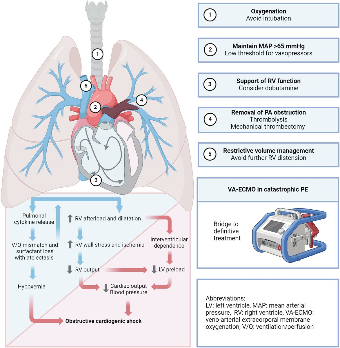 🔴Acute Pulmonary Embolism Management⤵️ #2025Review #openaccess 

🔹link.springer.com/article/10.100…
 #Cardiology #FOAMed #MedEd #medstudent #paramedic #Cardiology #CardioEd #medtwitter #meded #CardioTwitter #cardiotwiteros  #MedX #cardiovascular #MedTwitter #medical #medEd #cardiotwitter