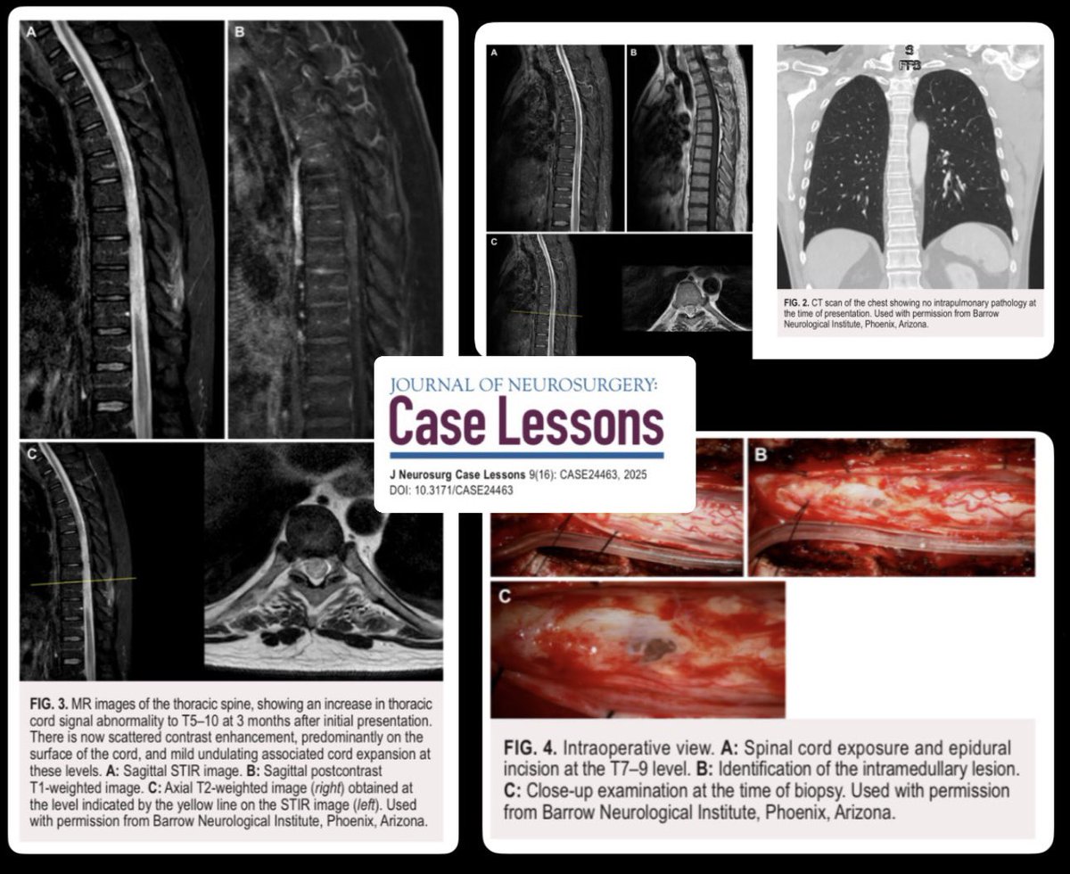#CaseStudy: Invasive aspergillosis is a rare diagnosis that typically arises in immunocompromised patients. Happy to provide a different case:immunocompetent patient with no sign of extraspinal infection, keep in mind for differentials. Link: thejns.org/caselessons/do…