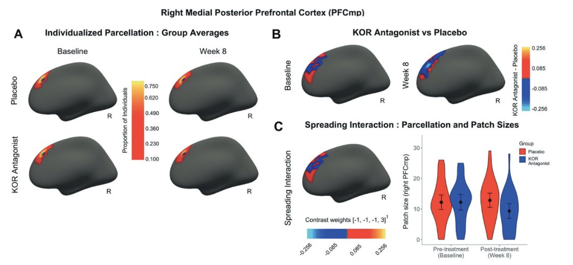Excited to share our new #research on selective KOR antagonism and individualized brain systems in mood and anxiety disorders is now published in <a href="/npp_journal/">Neuropsychopharmacology</a> (<a href="/SpringerNature/">Springer Nature</a>)! #MentalHealth #Neuroscience Read the article here: tinyurl.com/ysve5zrr