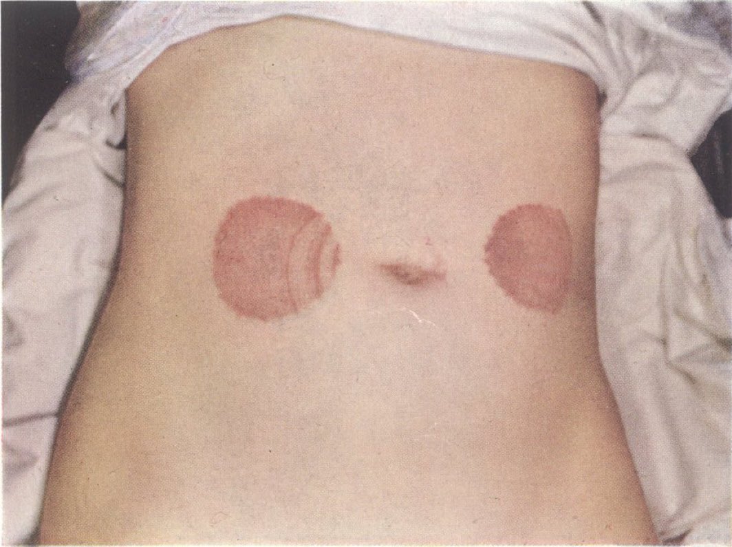Female patient with abdominal pain and this important clinical sign. What’s the diagnosis?