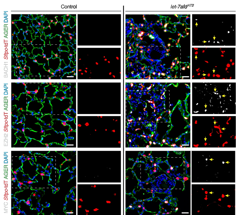 The Rodriguez lab (<a href="/ARodCastro/">AntonyRod. (microRNA Lab)</a>) identified let-7 as a central hub linking unchecked oncogenic signaling to impaired AT2 cell plasticity and #fibrogenesis. 🫁

📚 Read the full story in <a href="/NatureComms/">Nature Communications</a>: go.nature.com/3S01Bq7