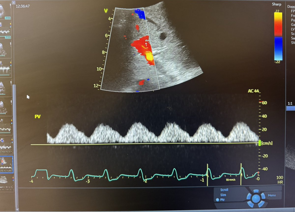 🩺 Hari (హరి 🇮🇳) Kalagara (@kalagarahari) on Twitter photo #POCUS
What is this trace 👇🏿?
What does it signify?
How would you deal ?
#VExUS <a href="/ASRA_Society/">ASRA Pain Medicine</a> <a href="/pandompatam/">Govind Panda</a> <a href="/nathanhwaldron/">Nathan Waldron</a> <a href="/SCCM/">SCCM</a> <a href="/NephroP/">NephroPOCUS</a> <a href="/ArgaizR/">Eduardo R Argaiz</a> <a href="/ross_prager/">Ross Prager</a> <a href="/ThinkingCC/">Philippe Rola</a> <a href="/msiuba/">Matt Siuba</a> <a href="/khaycock2/">korbinhaycockmd</a> <a href="/curromir/">Curro Miralles</a> <a href="/gokpocus/">Gokul Sagar</a> <a href="/KiranRikhraj/">Kiran Rikhraj</a> <a href="/pmgjones/">Philip Jones</a> <a href="/pmorenofranco/">Pablo Moreno Franco</a> <a href="/Wilkinsonjonny/">Jonny Wilkinson</a> <a href="/iceman_ex/">Segun Olusanya (He/Him) iceman_ex@critcare.social</a> #POCUS
What is this trace 👇🏿?
What does it signify?
How would you deal ?
#VExUS <a href="/ASRA_Society/">ASRA Pain Medicine</a> <a href="/pandompatam/">Govind Panda</a> <a href="/nathanhwaldron/">Nathan Waldron</a> <a href="/SCCM/">SCCM</a> <a href="/NephroP/">NephroPOCUS</a> <a href="/ArgaizR/">Eduardo R Argaiz</a> <a href="/ross_prager/">Ross Prager</a> <a href="/ThinkingCC/">Philippe Rola</a> <a href="/msiuba/">Matt Siuba</a> <a href="/khaycock2/">korbinhaycockmd</a> <a href="/curromir/">Curro Miralles</a> <a href="/gokpocus/">Gokul Sagar</a> <a href="/KiranRikhraj/">Kiran Rikhraj</a> <a href="/pmgjones/">Philip Jones</a> <a href="/pmorenofranco/">Pablo Moreno Franco</a> <a href="/Wilkinsonjonny/">Jonny Wilkinson</a> <a href="/iceman_ex/">Segun Olusanya (He/Him) iceman_ex@critcare.social</a>