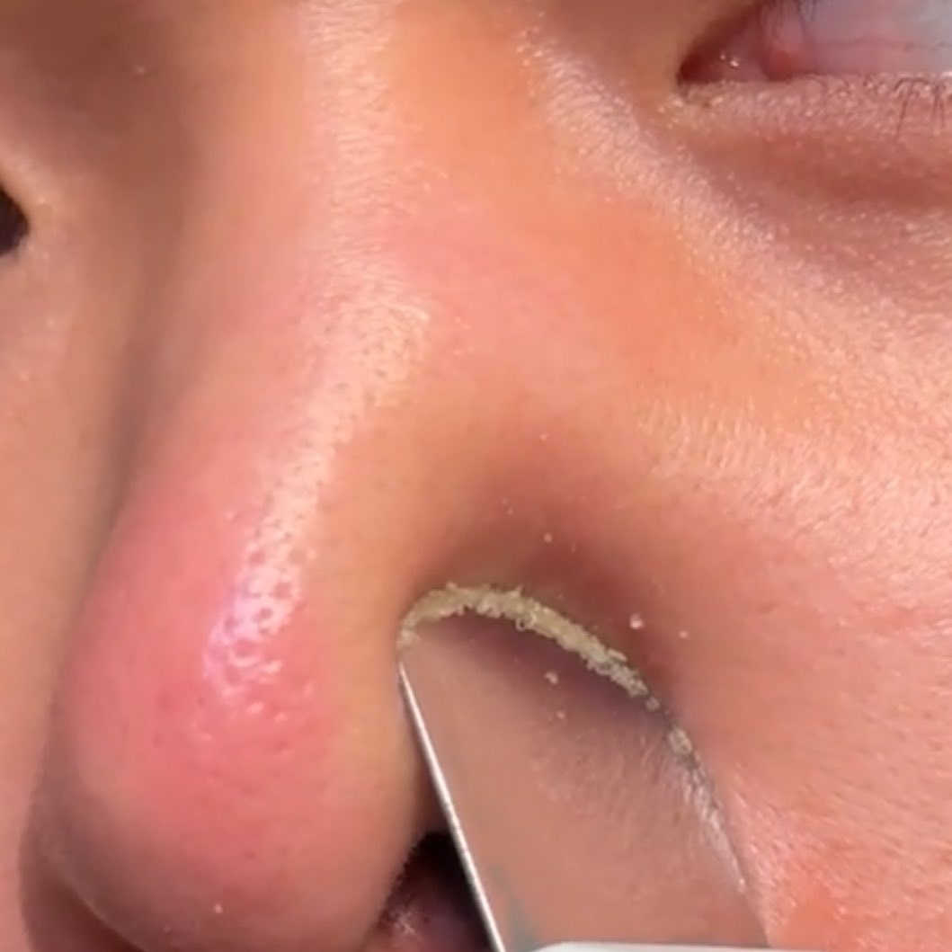 Geli tapi puasnya tengo she effortlessly remove segala black/whiteheads kat hidung😳 

Thanks sister review!! Ive been looking for WAYS utk buang gunk kt hidung ni.. susah gilaaa