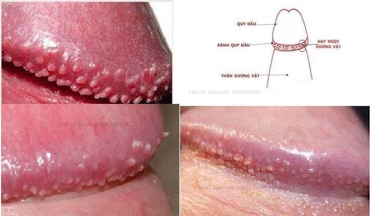 DsiAnhTu's tweet photo. XOÁ HẠT NGỌC VĨNH VI��N
TĂNG THẨM MỸ CHO "CẬU NHỎ"
Zalo tư vấn: 0832337855 https://t.co/fOWiZwVM4b