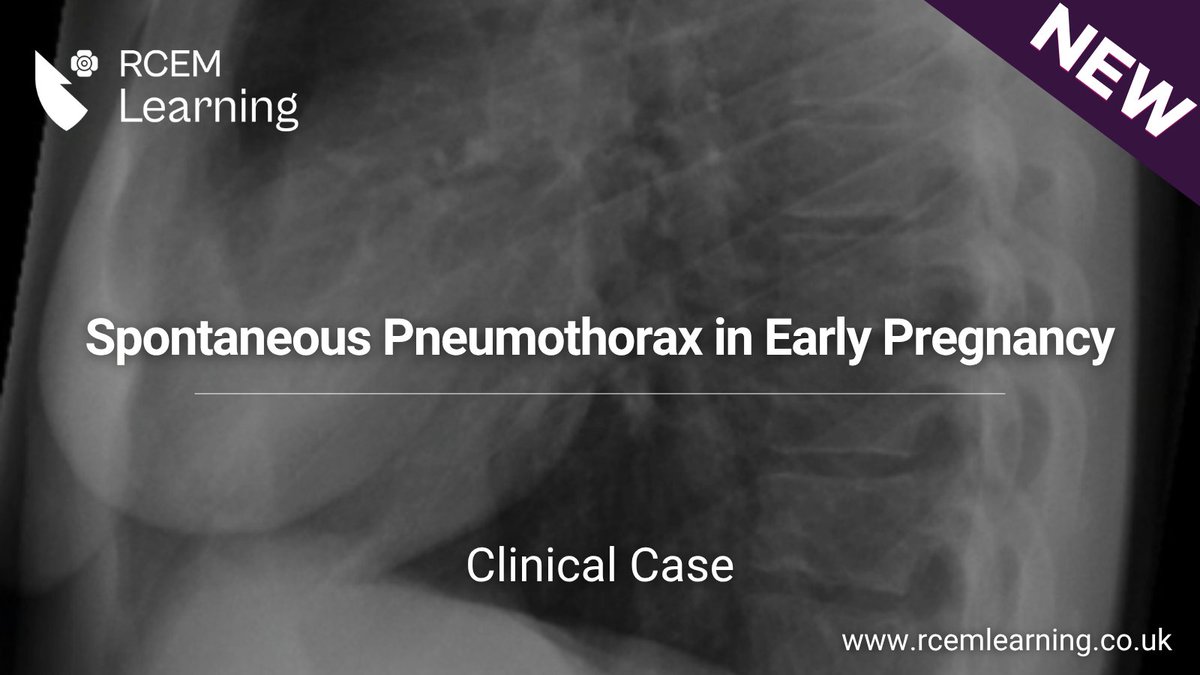 RCEMLearning (@rcemlearning) on Twitter photo NEW: A 31-year-old woman presents with a one-day history of sudden onset of the left shoulder pain and shortness of breath.
Read our latest #ClinicalCase here: rcemlearning.co.uk/modules/sponta… NEW: A 31-year-old woman presents with a one-day history of sudden onset of the left shoulder pain and shortness of breath.
Read our latest #ClinicalCase here: rcemlearning.co.uk/modules/sponta…