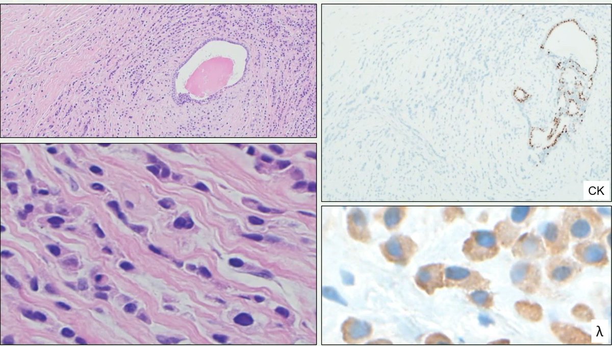 Breast-Challenges in diagnosis
Case diagnosed as invasive lobular carcinoma due to negativity for ecadherin
This lesion was also triple negative and CK negative
Patient had history of plasma cell neoplasm
Lambda stains were positive
Final diagnosis: metastasis of a plasma cell